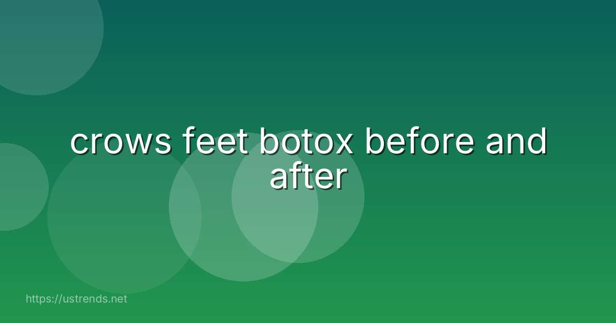 crows feet botox before and after